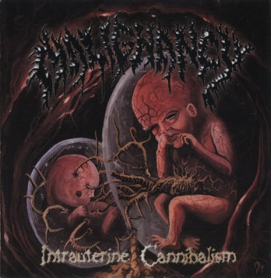 MALIGNANCY - Intrauterine Cannibalism